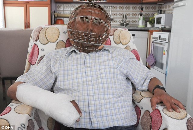 Ibrahim Yucel, l’uomo che ha una gabbia in testa per 23 ore al giorno. Il motivo? Smettere di fumare