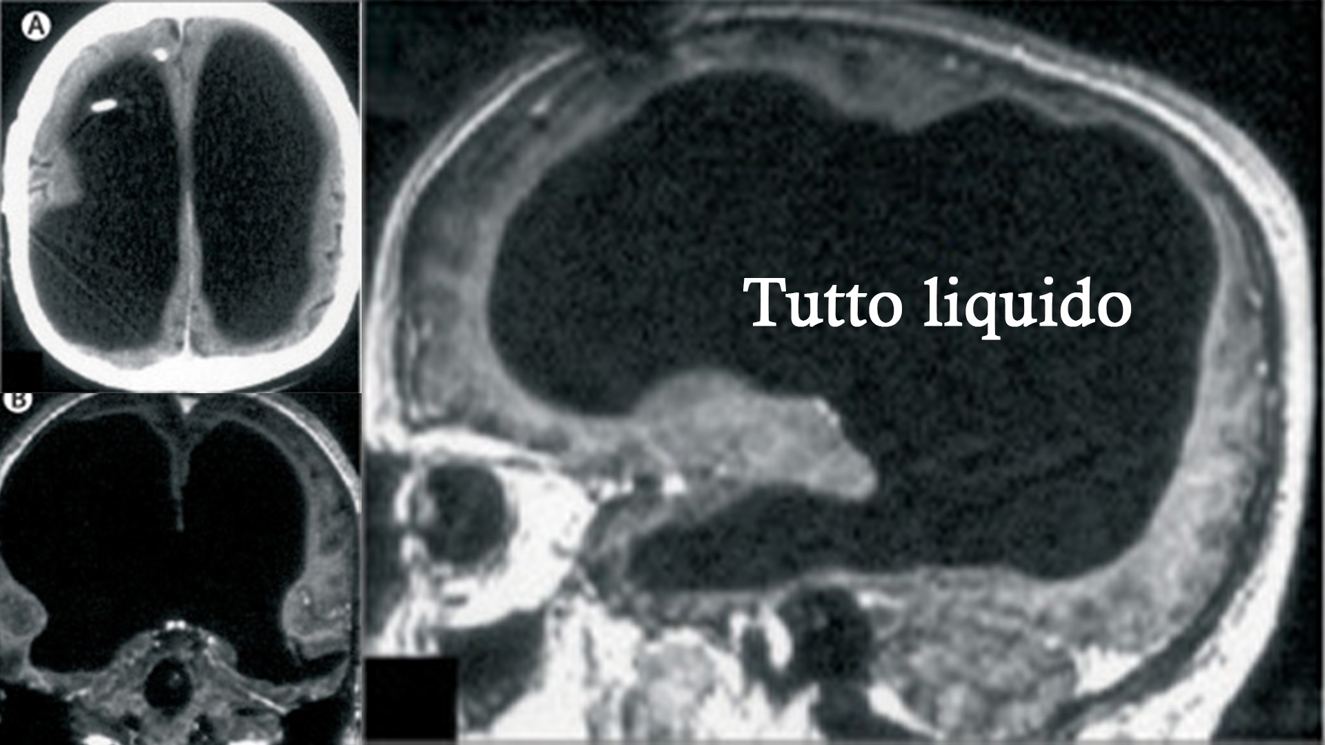 L’uomo che visse normalmente senza il 90% del cervello. Come fu possibile?